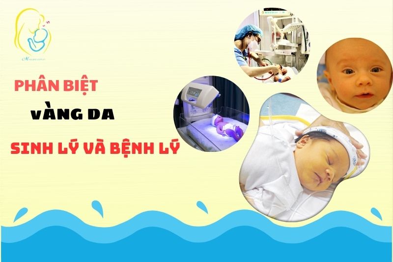 Phân biệt vàng da sinh lý - bệnh lý và cách xử lý